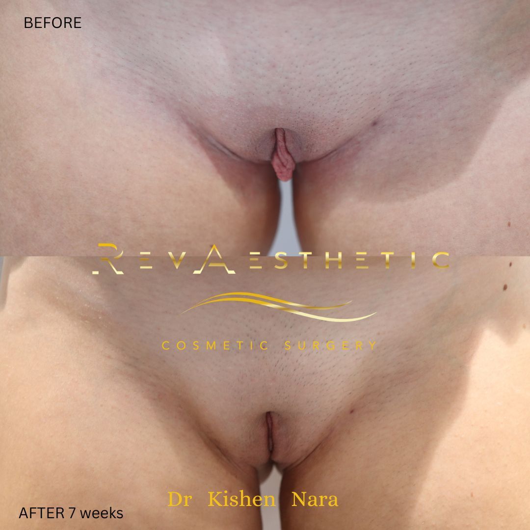 SAP labiaplasty — after